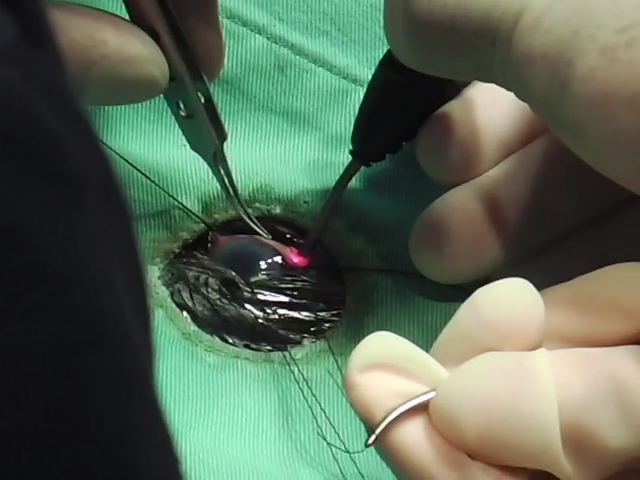 緑内障レーザー手術 緑内障レーザー手術